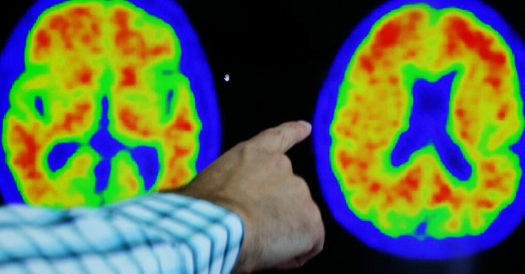 Evidence of Alzheimer’s disease on PET scans at the Center for Alzheimer Research and Treatment in Boston